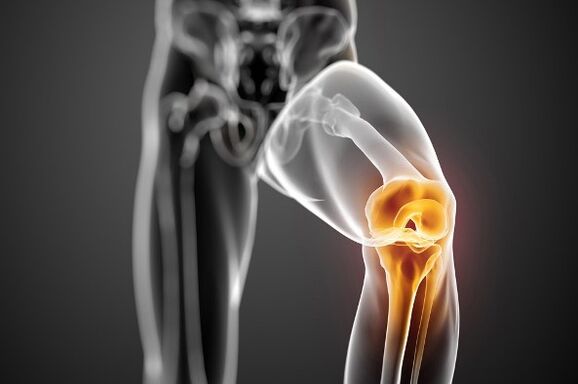 Knee joint osteoarthritis