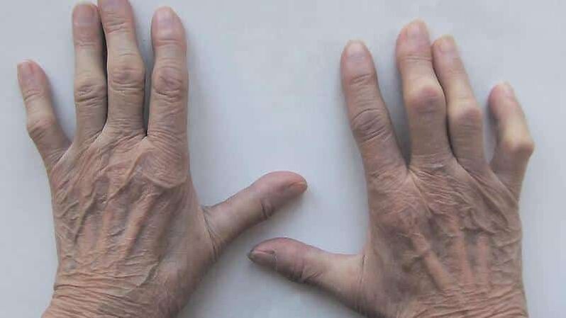 Methods for treating pain in fingers