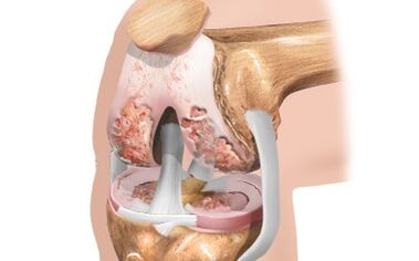 Knee joint osteoarthritis
