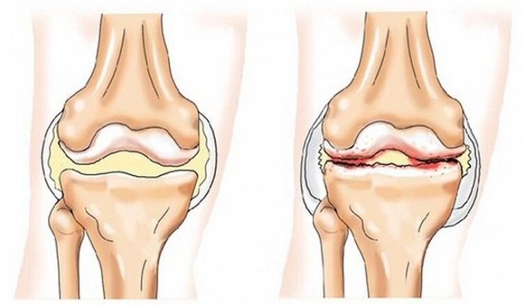 Healthy articulation and articulation affected by osteoarthritis
