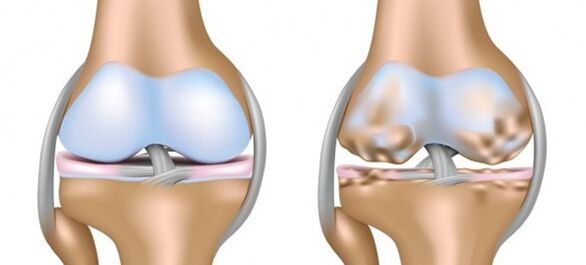 Healthy cartilage and cartilage affected by osteoarthritis.