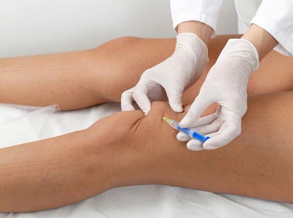 Intra-articular injection for knee osteoarthritis.