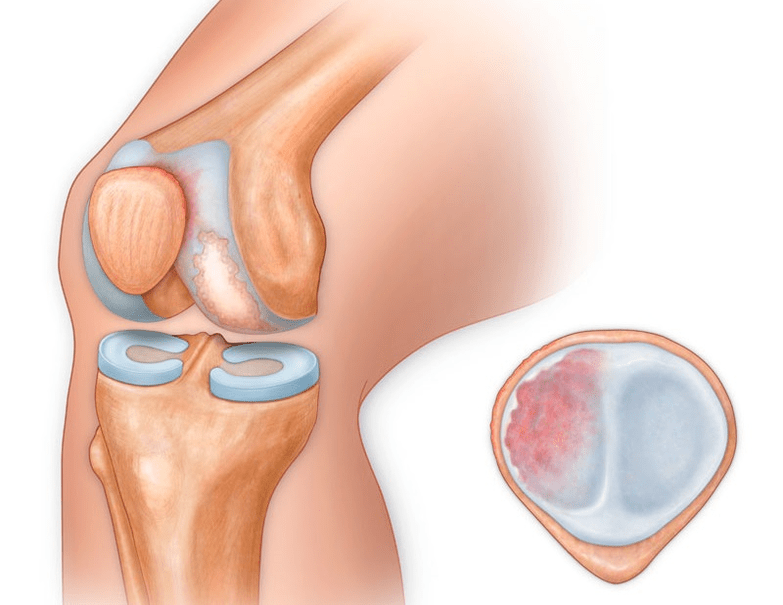 What does osteoarthritis of the knee joint look like