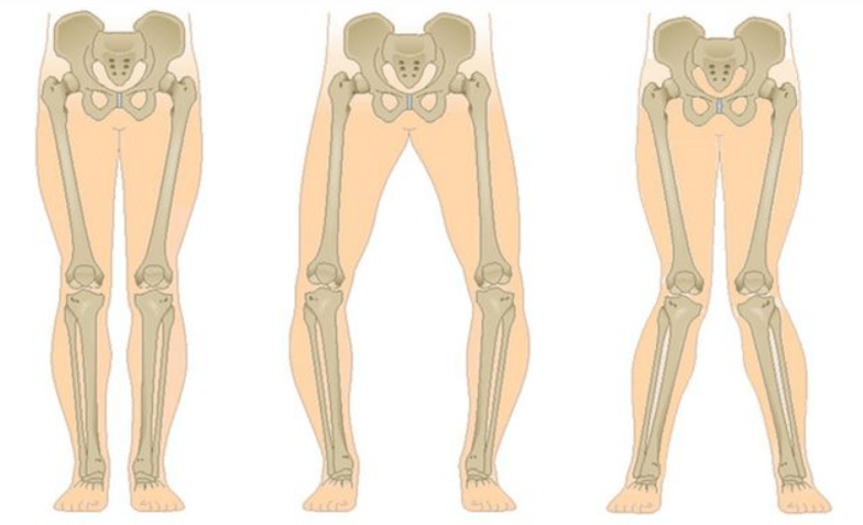 complications of knee osteoarthritis