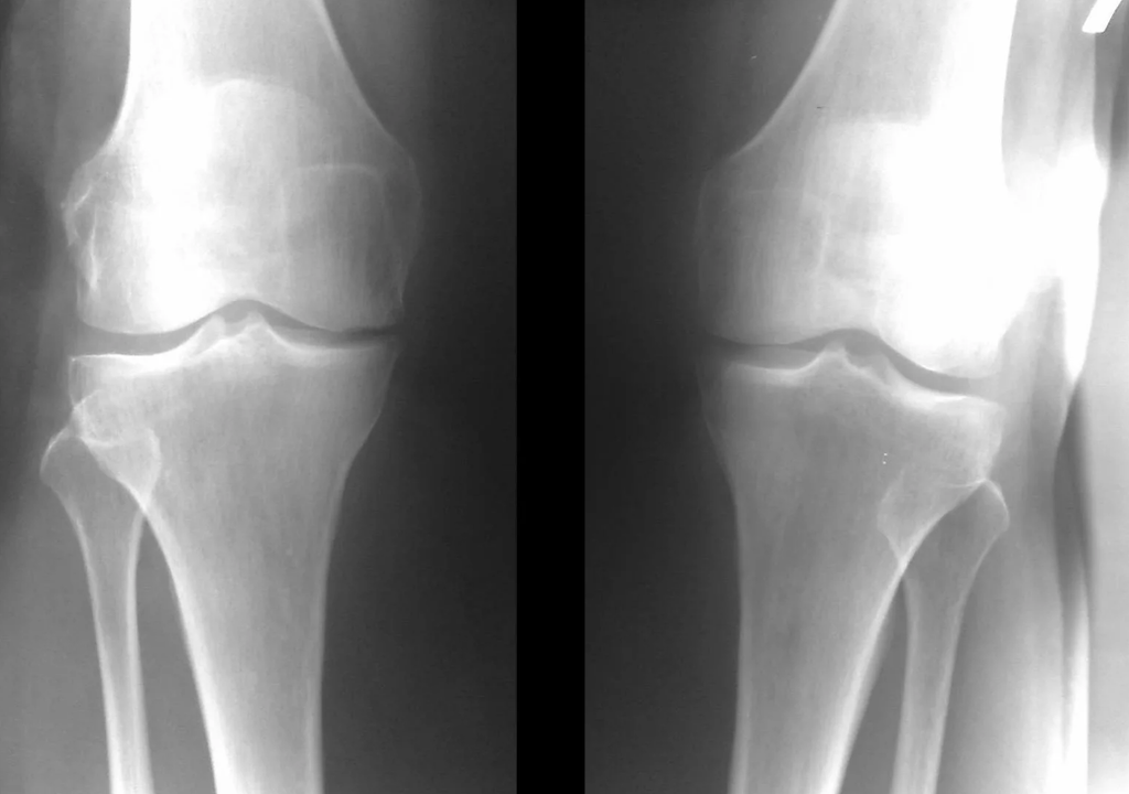 diagnosis of osteoarthritis of the knee joint