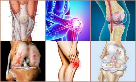 development of knee osteoarthritis