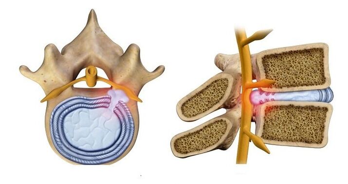 Herniated intervertebral disc protrusion of the nucleus of the disc into the spinal canal